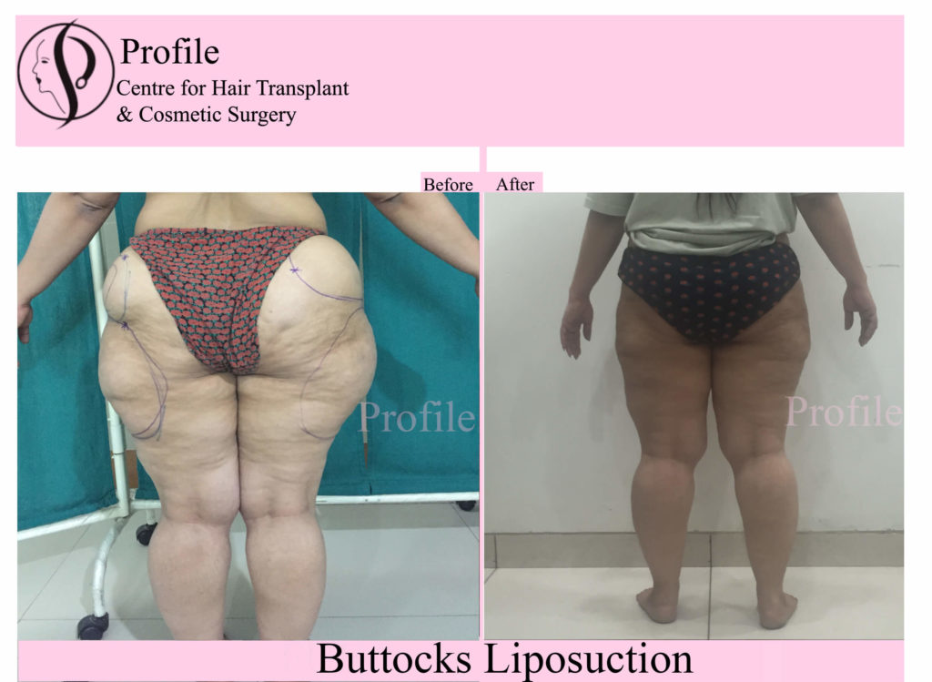 liposuction results