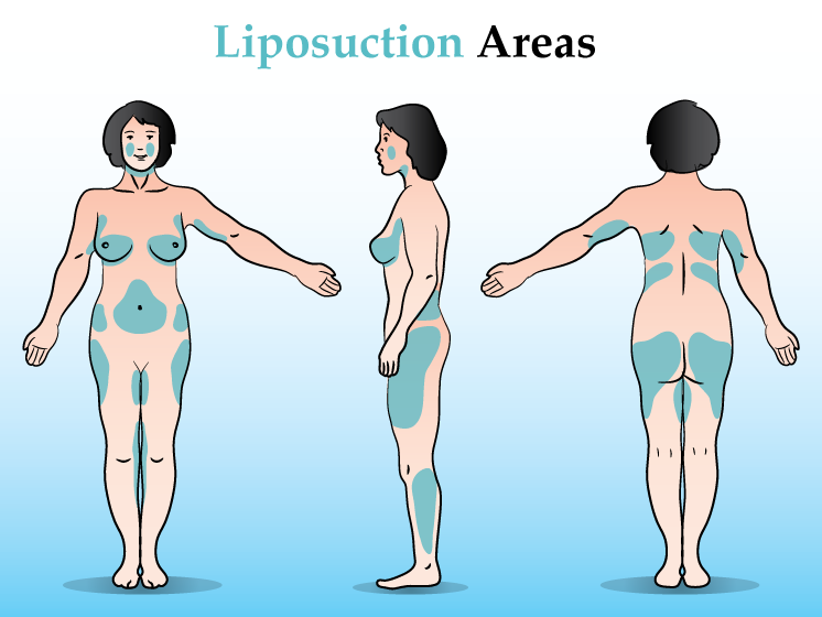 Liposuction areas