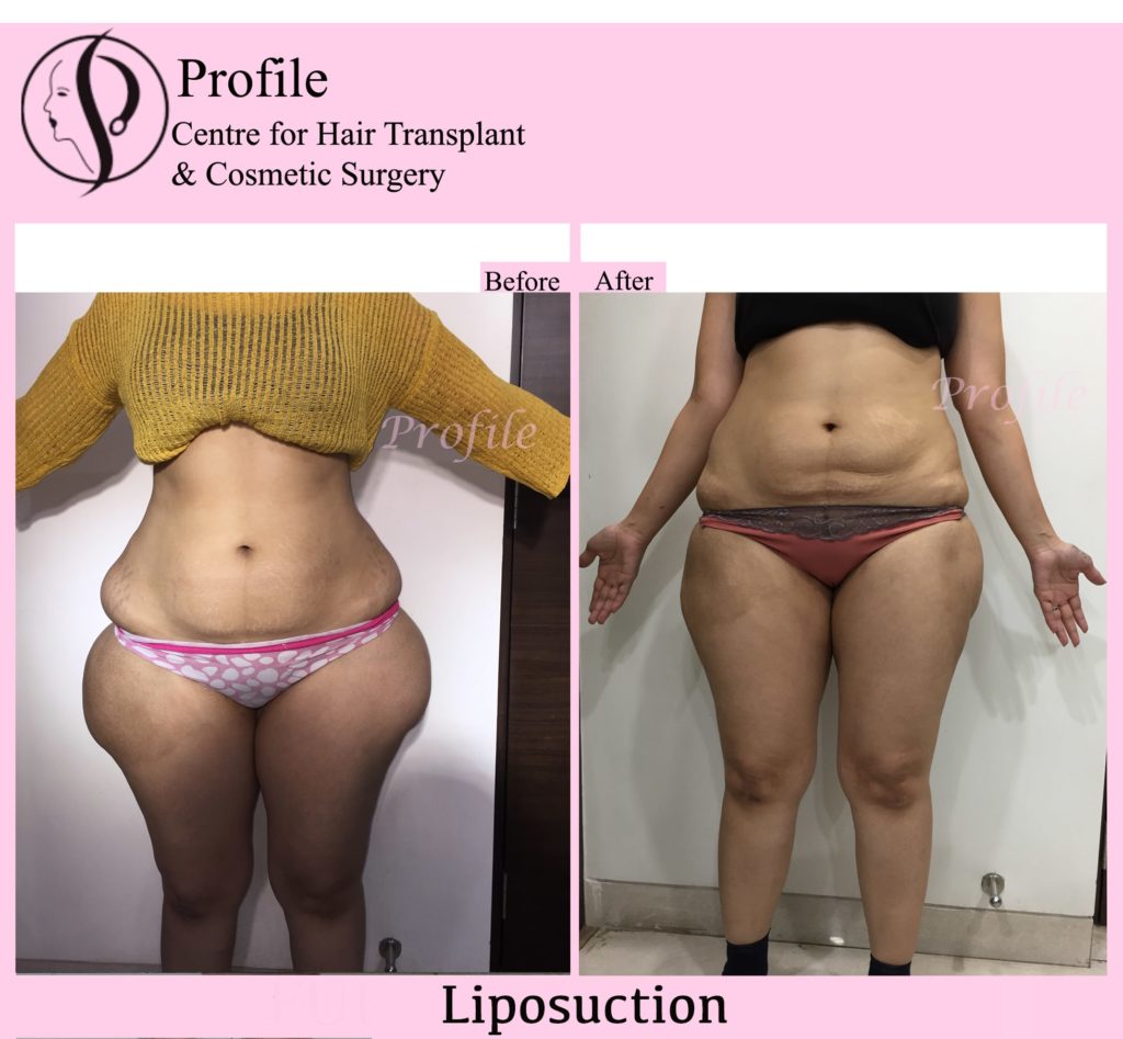 Liposuction results