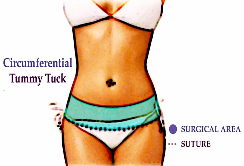 Tummy Tuck Procedure