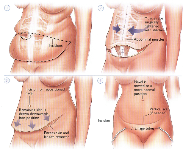 Tummy Tuck abdominoplasty procedure