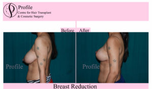 Breast Reduction Surgery results
