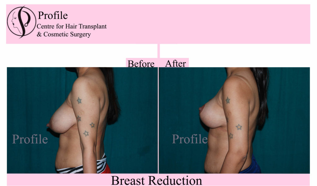 breast reduction results