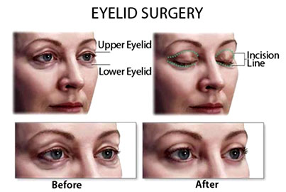 Blepharoplasty or Eyelid Rectification 