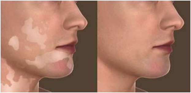 Vitiligo treatment results
