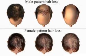 male female hair loss pattern