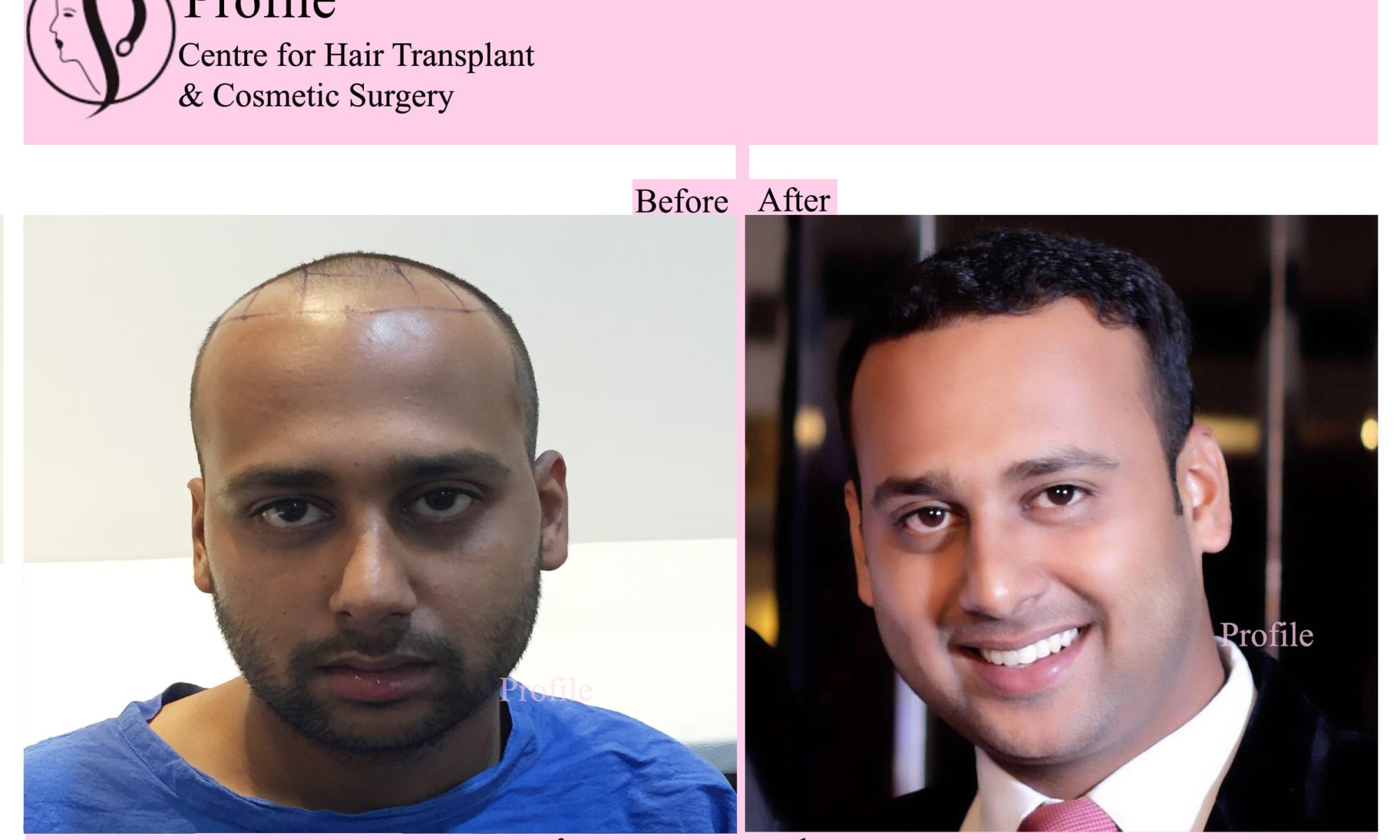 FUE Hair Transplant Tips And Treatment