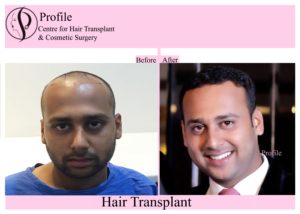happy hair transplant results