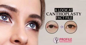 A look at Canthoplasty fact file