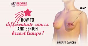 When Is It Normal To Worry About Breast Lumps
