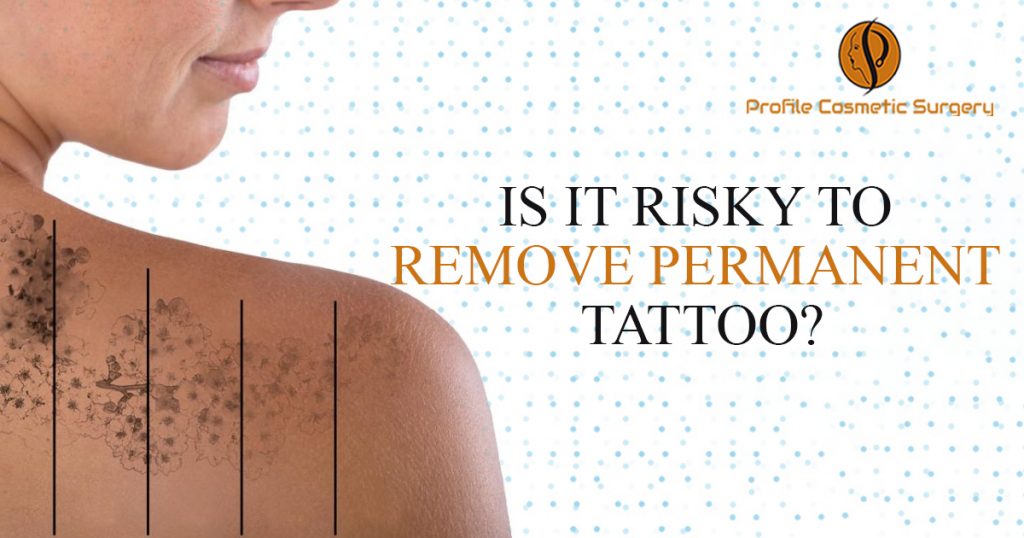 Is It Risky To Remove Permanent Tattoo
