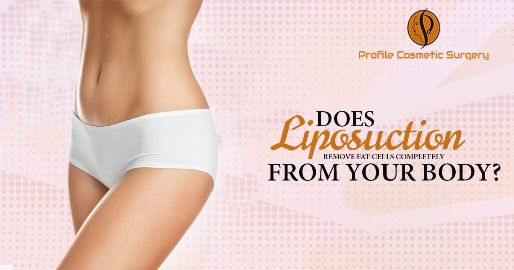 Does Liposuction Remove Fat Cells completely from your body