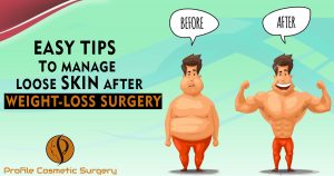 Easy Tips To Manage Loose Skin After Weight-loss Surgery