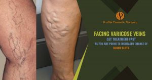 facing Varicose Veins - Get treatment fast as you are prone to increased chance of Blood clots
