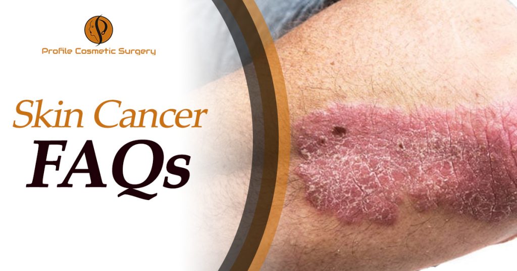 Skin-Cancer-FAQs
