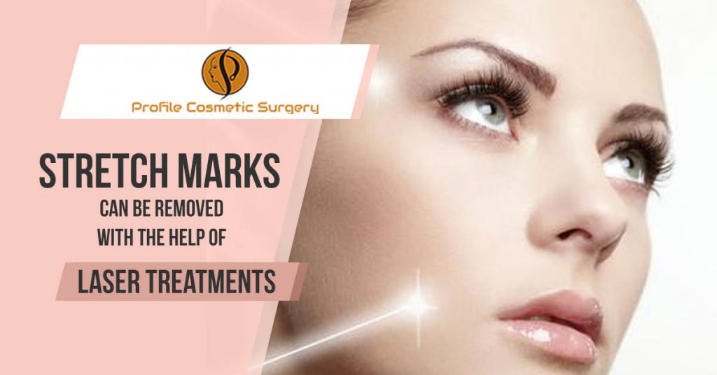 Stretch-Marks-can-be-removed-with-the-help-of-Laser-Treatments