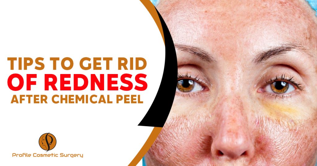 Tips To Get Rid of Redness After Chemical Peel