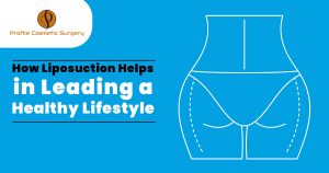 How Liposuction Helps in Leading a healthy lifestyle