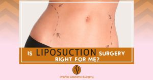 Is Liposuction Surgery Right for me
