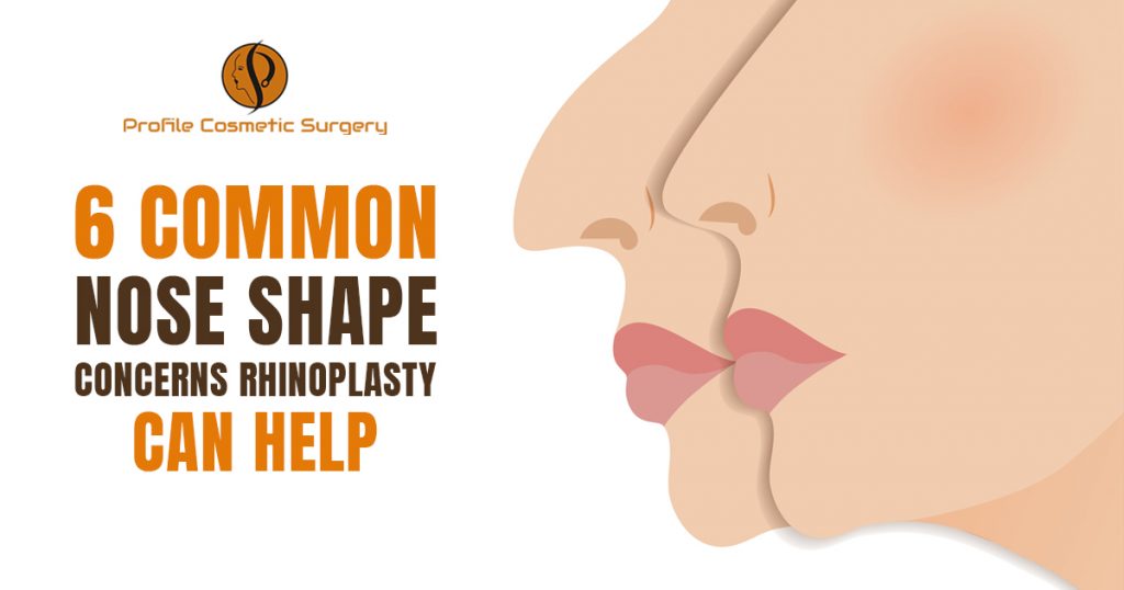 6 Common Nose Shape Concerns Rhinoplasty Can Help