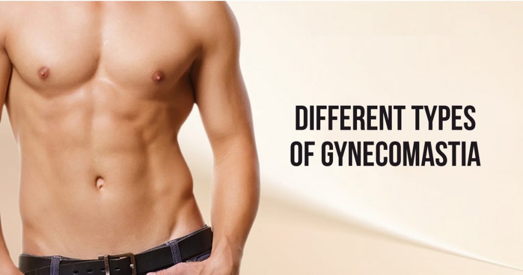 Different Types of Gynecomastia levels & grades
