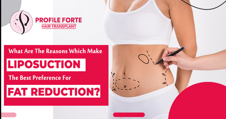 What-are-the-reasons-which-make-liposuction-the-best-preference-for-fat-reduction