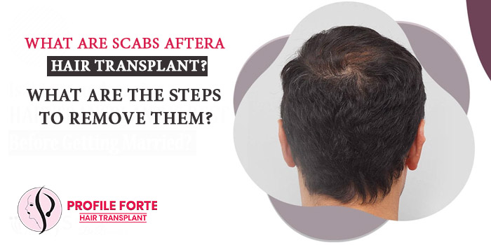 What are scabs after a hair transplant? What are the steps to remove them?  – Blog – Profile Studios