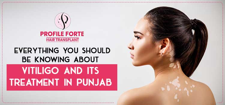 Everything-you-should-be-knowing-about-vitiligo-and-its-treatment-in-Punjab-pro-jpg