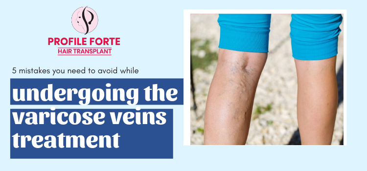 _ 5 mistakes you need to avoid while undergoing the varicose veins treatment