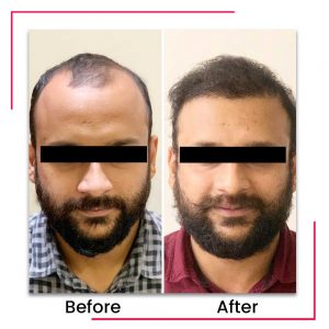 Before after hair transplant surgery