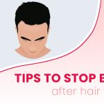Tips To Stop Bleeding After Hair Transplant