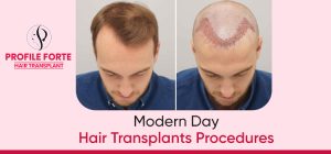 Modern Day Hair Transplants Procedures