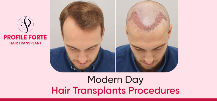 Body Hair Transplant (BHT): A Boon For Hair Thinning Patient – Blog –  Profile Studios