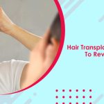 Hair Transplant Finest Solution To Revive Lost Hair