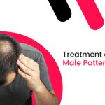Treatment and Causes Of Male Pattern Baldness