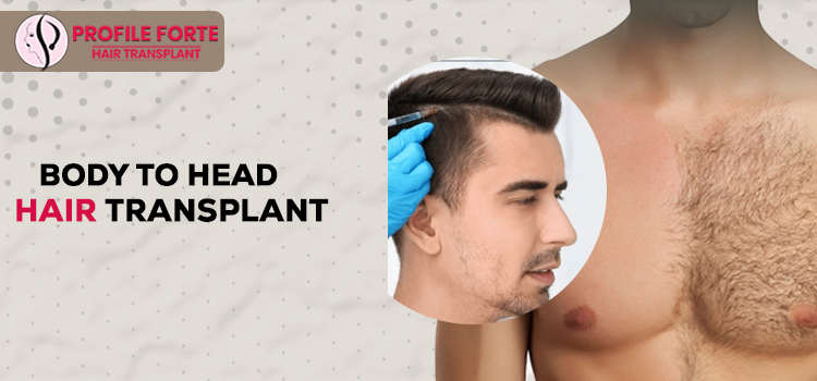Detailed guide on the Body to head hair transplant treatment – Blog –  Profile Studios