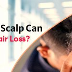 Does Dry Scalp Can Lead To Hair Loss?