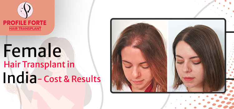 You Should Know the Female Hair Transplant in India: Cost & Results – Blog  – Profile Studios