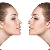 Nose-reshaping