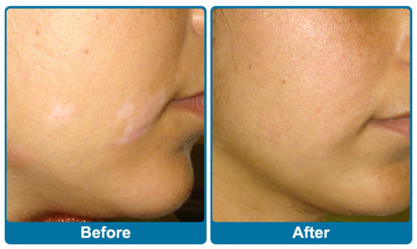 Vitiligo Treatment in India Vitiligo Surgery Ludhiana Punjab