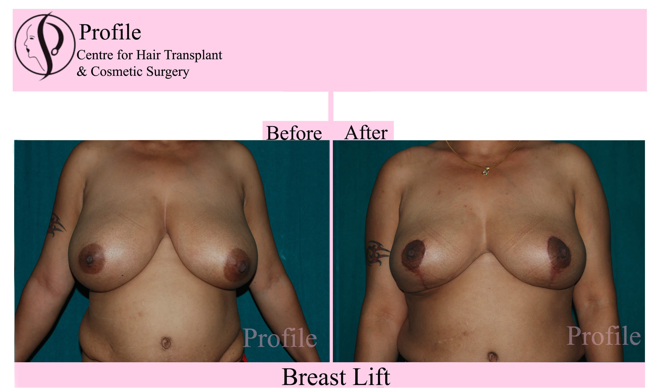 breast lift front