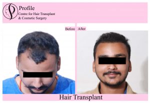 Hair Transplant in Ludhiana Result Before  After  Celebrity  YouTube