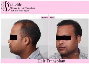 Hair Transplant in Ludhiana, Punjab