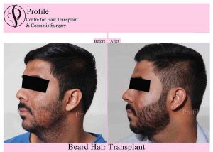 beard hair transplant
