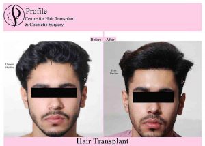 hair transplant results