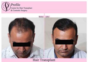 hair transplant results